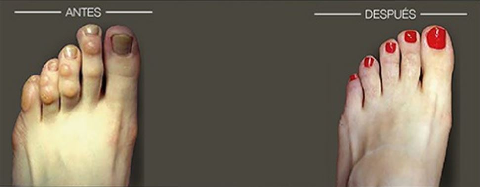 Tratamiento  de Dedo en Garra en clínica Unidad de Cirugía del Pie