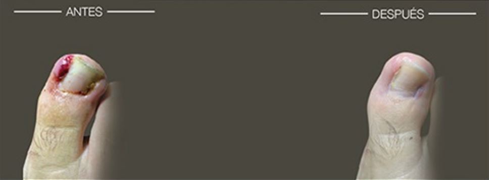 Tratamiento  de Uña Encarnada en clínica Unidad de Cirugía del Pie