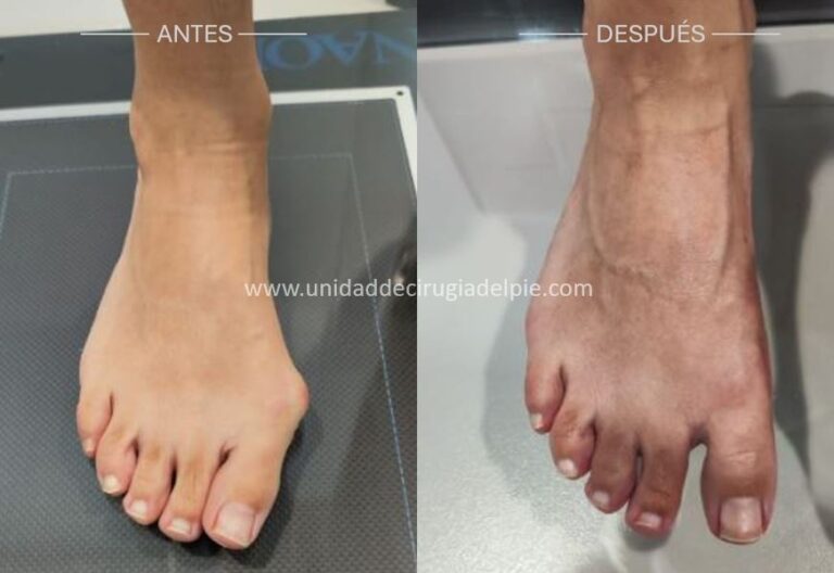 Operación de Juanete Octubre 2025