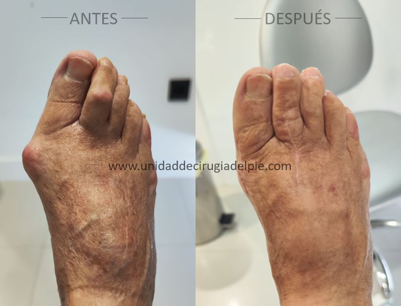 Cirugía de Juanete y Dedo en Garra Noviembre 2025