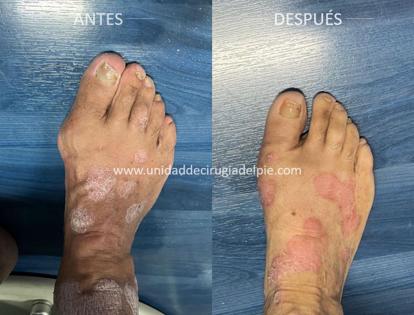 Operación de Juanete de Pie Diciembre 2025