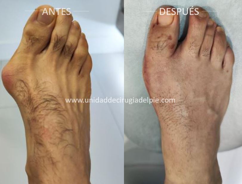 Operación de Juanete de Pie Enero 2026