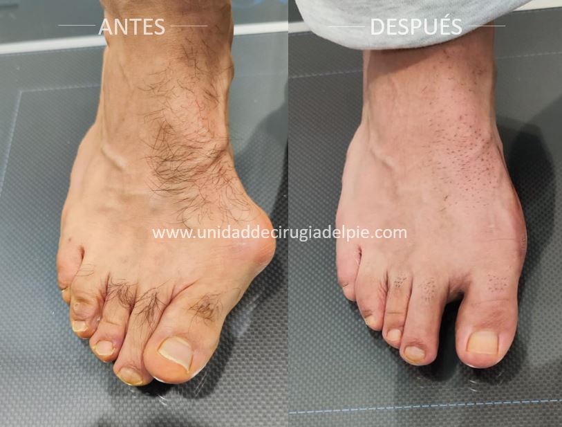 Cirugía de Juanete de Pie Albacete Marzo 2026 A