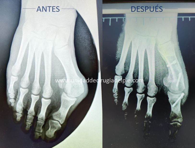 Cirugía de Juanete de Pie Albacete Marzo 2026 B