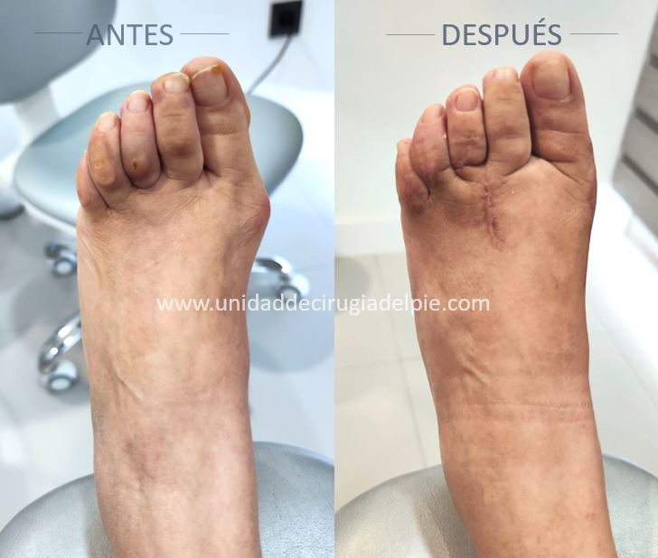 Cirugía Pie Juanete y Dedos en Garra Mayo 2026